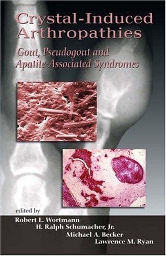 Tapa de Crystal-induced arthropathies