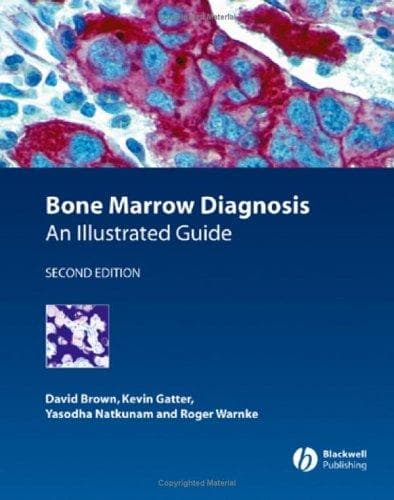 Tapa de Bone marrow diagnosis