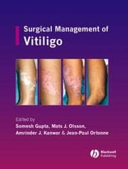 Tapa de Surgical management of vitiligo