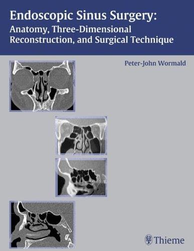 Tapa de Endoscopic sinus surgery