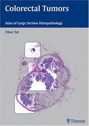 Tapa de Colorectal Tumors