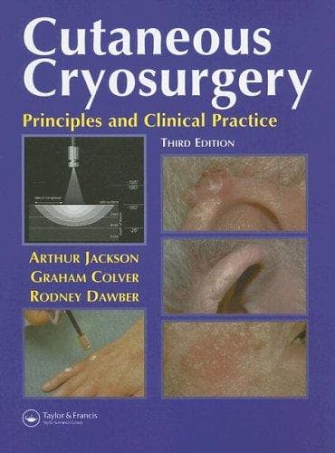 Tapa de Cutaneous Cryosurgery