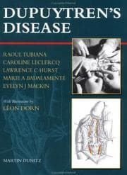 Tapa de Dupuytren's disease