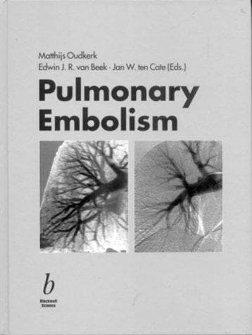 Tapa de Pulmonary embolism