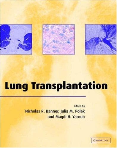 Tapa de Lung transplantation