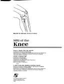 Tapa de MRI of the Knee