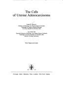 Tapa de Cells of Uterine Adenocarcinoma