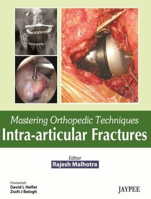 Tapa de Intraarticular Fractures