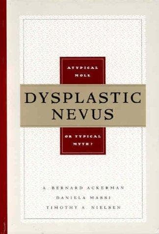 Tapa de Dysplastic nevus