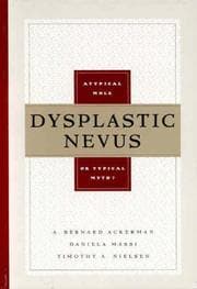 Tapa de Dysplastic nevus