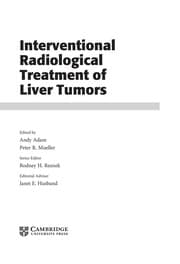 Tapa de Interventional radiological treatment of liver tumors